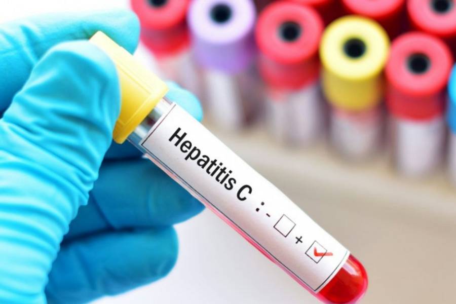 8 de cada 10 pacientes con hepatitis C no saben que la tienen