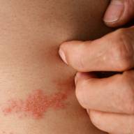 Preocupación por incremento de casos de Herpes Zoster