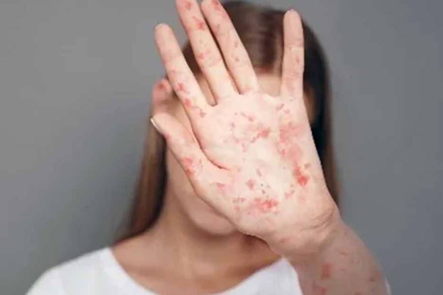 Alerta del Ministerio de Salud por posibles contagios de sarampión en distintos puntos del país