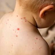 Sarampión: no se detectaron nuevos contagios y hubo provisión de vacunas