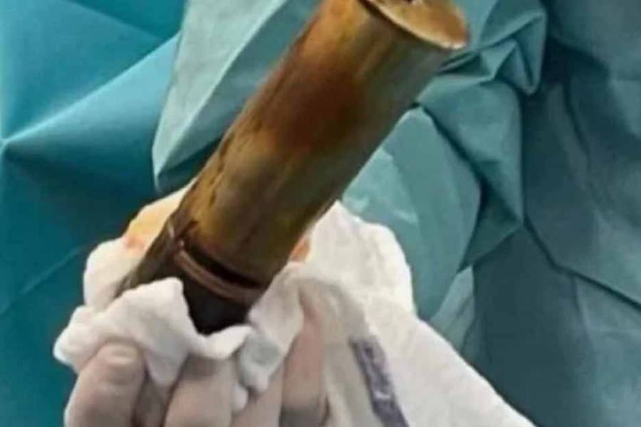 Evacúan hospital en Toulouse por proyectil de la Primera Guerra Mundial alojado en un paciente