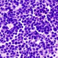 ANMAT aprueba un tratamiento para mieloma múltiple avanzado con pocas opciones terapéuticas