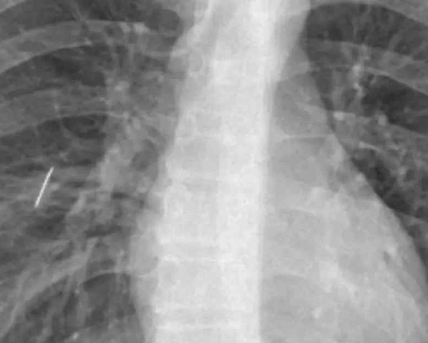 Le extraen una aguja de un pulmón a un niño en Catamarca