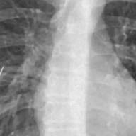 Le extraen una aguja de un pulmón a un niño en Catamarca